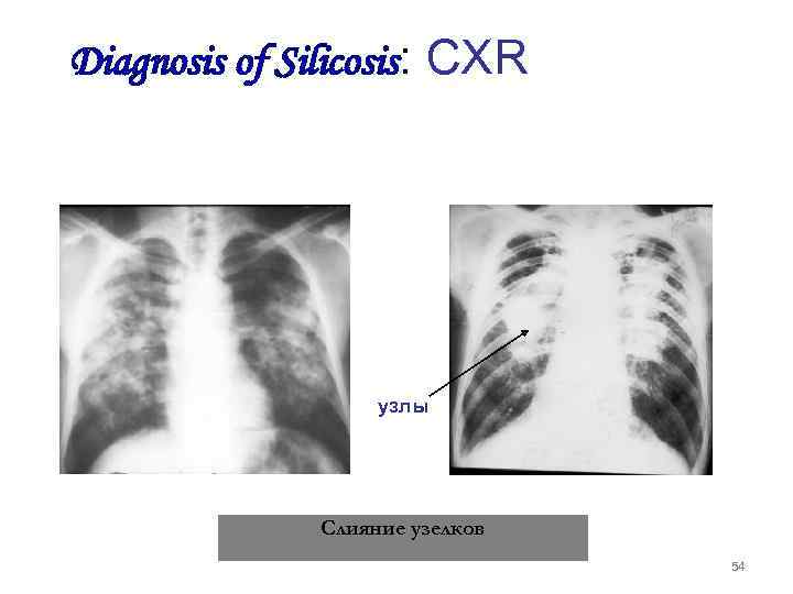 Diagnosis of Silicosis: CXR узлы Слияние узелков 54 