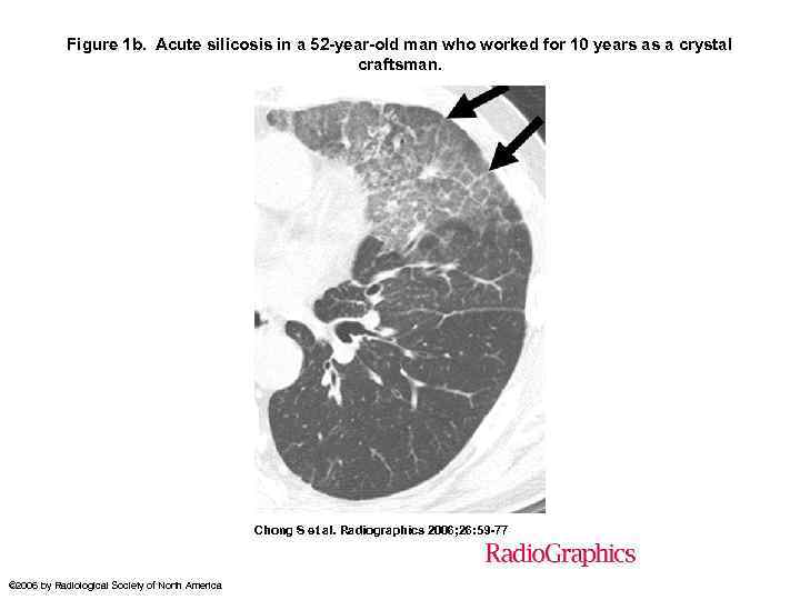 Figure 1 b. Acute silicosis in a 52 -year-old man who worked for 10