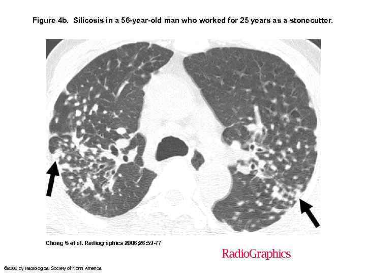 Figure 4 b. Silicosis in a 56 -year-old man who worked for 25 years