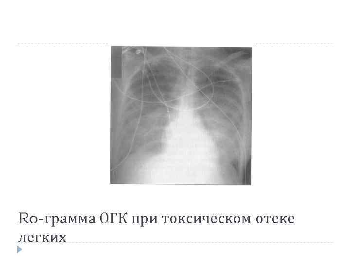 Ro-грамма ОГК при токсическом отеке легких 