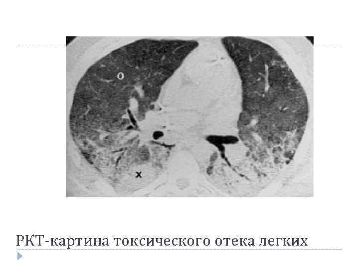 РКТ-картина токсического отека легких 