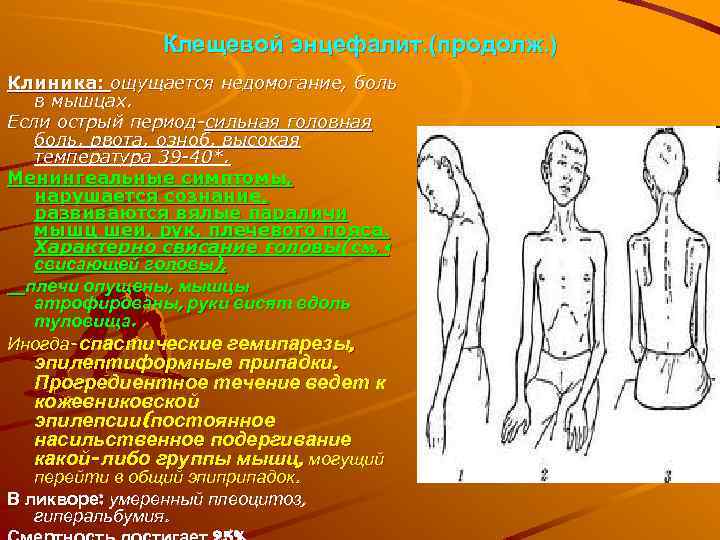 Менингеальная форма клещевого энцефалита. Клещевой энцефалит ликвор. Менингеальные симптомы при клещевом энцефалите.