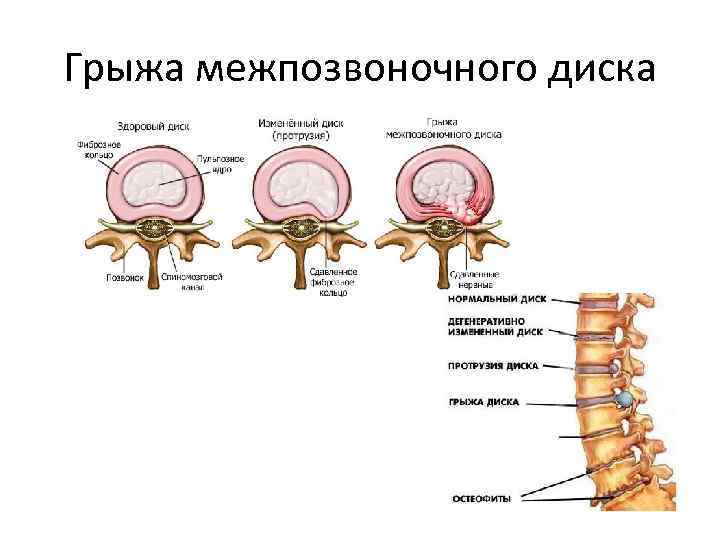Грыжа межпозвоночного диска 