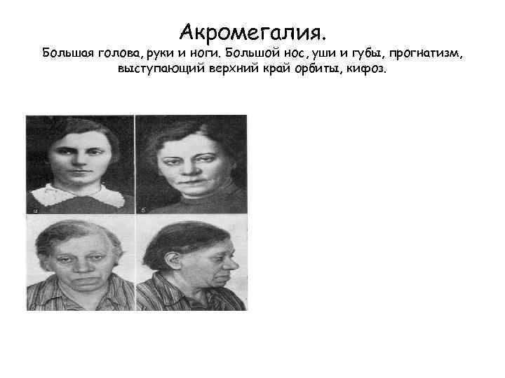 Акромегалия. Большая голова, руки и ноги. Большой нос, уши и губы, прогнатизм, выступающий верхний