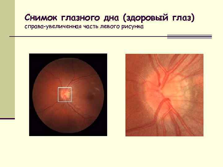 Офтальмоскопическая картина нормального глазного дна характеризуется