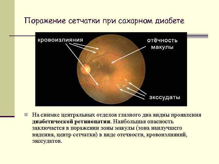 Поражение сетчатки при сахарном диабете n На снимке центральных отделов глазного дна видны проявления