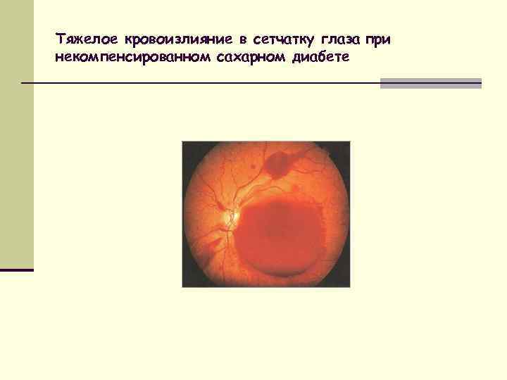 Тяжелое кровоизлияние в сетчатку глаза при некомпенсированном сахарном диабете 