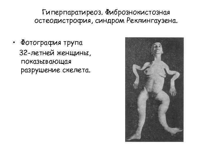 Гиперпаратиреоз. Фибрознокистозная остеодистрофия, синдром Реклингаузена. • Фотография трупа 32 -летней женщины, показывающая разрушение скелета.