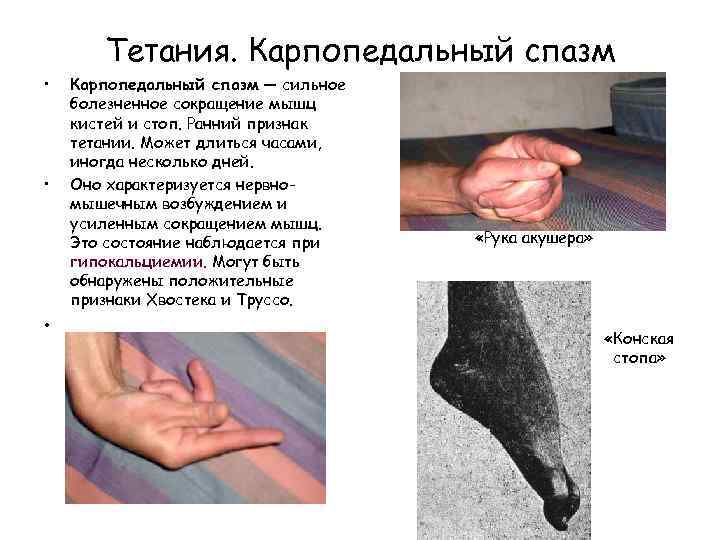 Тетания. Карпопедальный спазм • • • Карпопедальный спазм — сильное болезненное сокращение мышц кистей