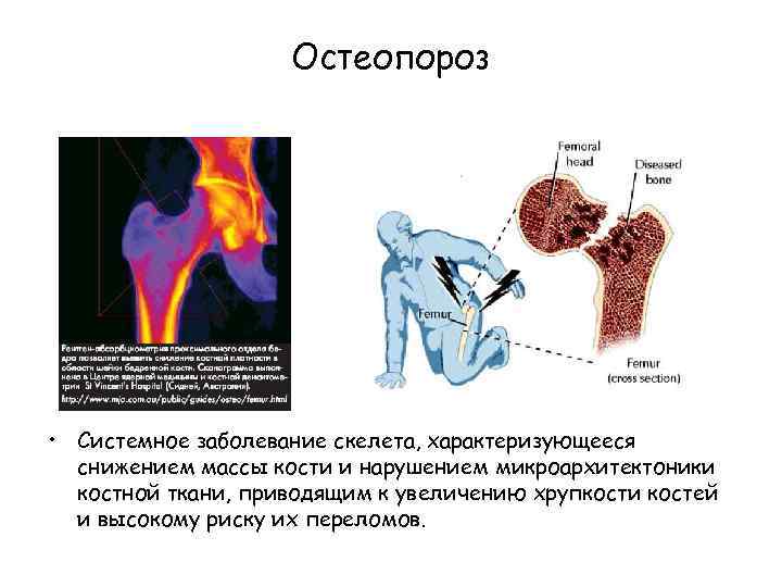Остеопороз • Системное заболевание скелета, характеризующееся снижением массы кости и нарушением микроархитектоники костной ткани,
