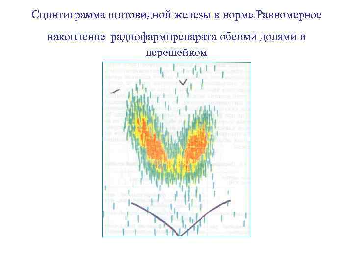 Сцинтиграмма щитовидной железы в норме. Равномерное накопление радиофармпрепарата обеими долями и перешейком 