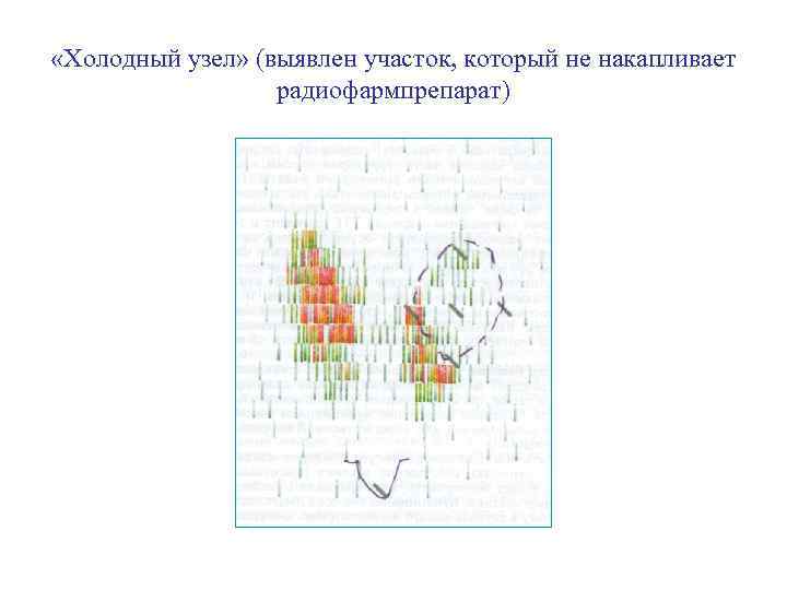  «Холодный узел» (выявлен участок, который не накапливает радиофармпрепарат) 