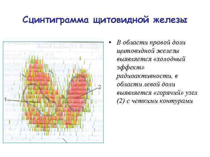 Сцинтиграмма щитовидной железы • В области правой доли щитовидной железы выявляется «холодный эффект» радиоактивности,