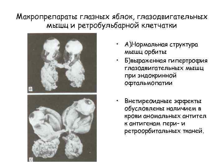 Макропрепараты глазных яблок, глазодвигательных мышц и ретробульбарной клетчатки • А)Нормальная структура мышц орбиты •