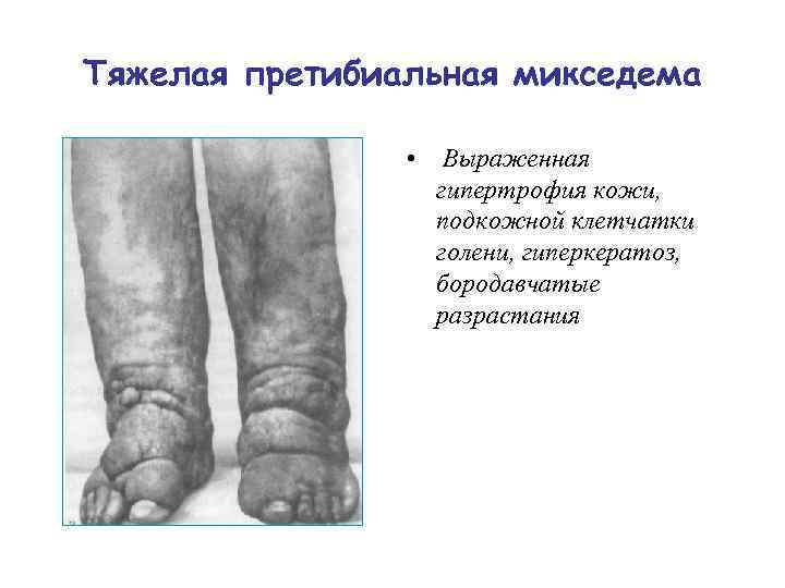 Тяжелая претибиальная микседема • Выраженная гипертрофия кожи, подкожной клетчатки голени, гиперкератоз, бородавчатые разрастания 
