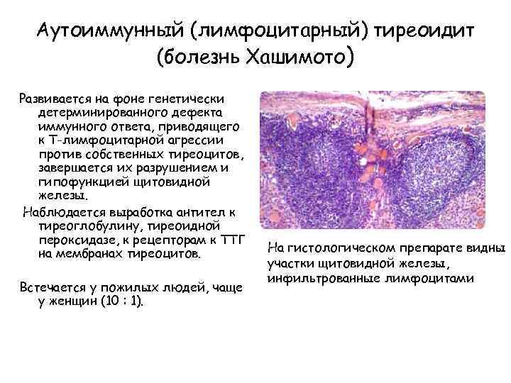 Цитологическая картина тиреоидита хашимото