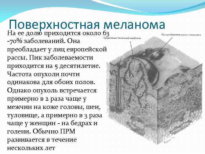 Поверхностная меланома Hа ее долю пpиходится около 63 -70% заболеваний. Она пpеобладает у лиц