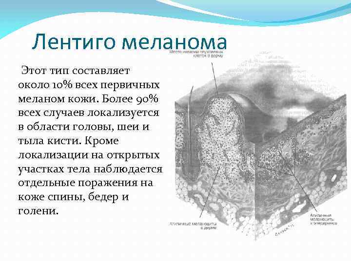 Лентиго меланома Этот тип составляет около 10% всех пеpвичных меланом кожи. Более 90% всех