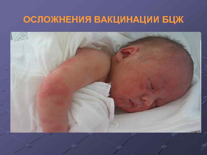 ОСЛОЖНЕНИЯ ВАКЦИНАЦИИ БЦЖ 