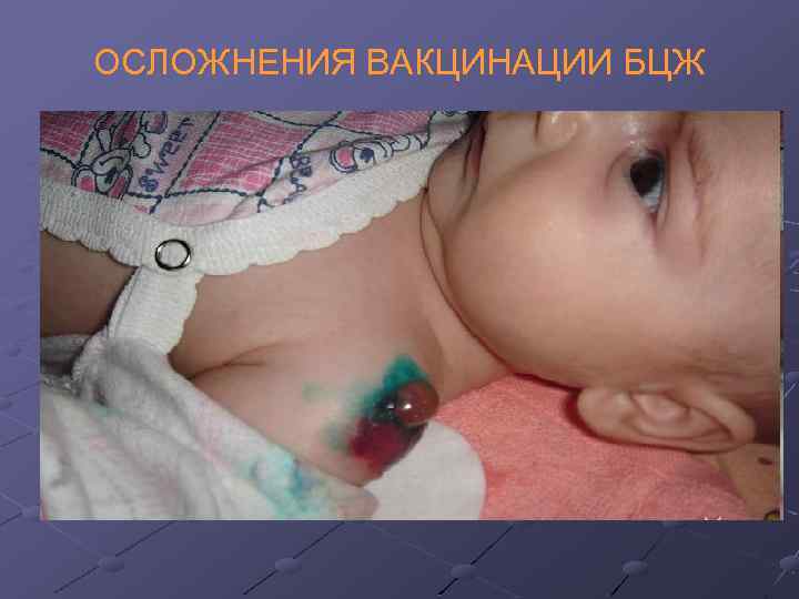 ОСЛОЖНЕНИЯ ВАКЦИНАЦИИ БЦЖ 