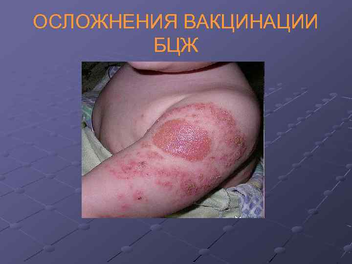 ОСЛОЖНЕНИЯ ВАКЦИНАЦИИ БЦЖ 