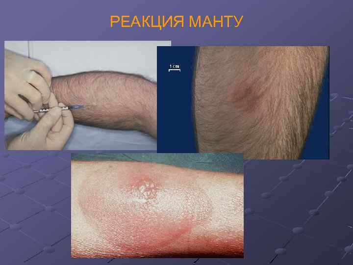 РЕАКЦИЯ МАНТУ 