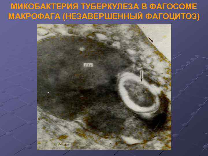 МИКОБАКТЕРИЯ ТУБЕРКУЛЕЗА В ФАГОСОМЕ МАКРОФАГА (НЕЗАВЕРШЕННЫЙ ФАГОЦИТОЗ) 