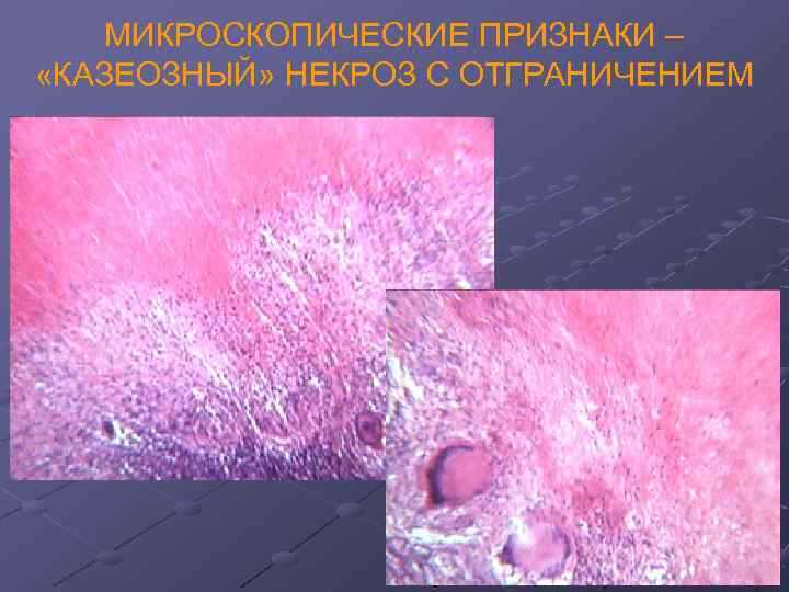 МИКРОСКОПИЧЕСКИЕ ПРИЗНАКИ – «КАЗЕОЗНЫЙ» НЕКРОЗ С ОТГРАНИЧЕНИЕМ 