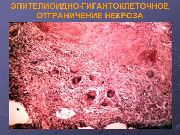 ЭПИТЕЛИОИДНО-ГИГАНТОКЛЕТОЧНОЕ ОТГРАНИЧЕНИЕ НЕКРОЗА 