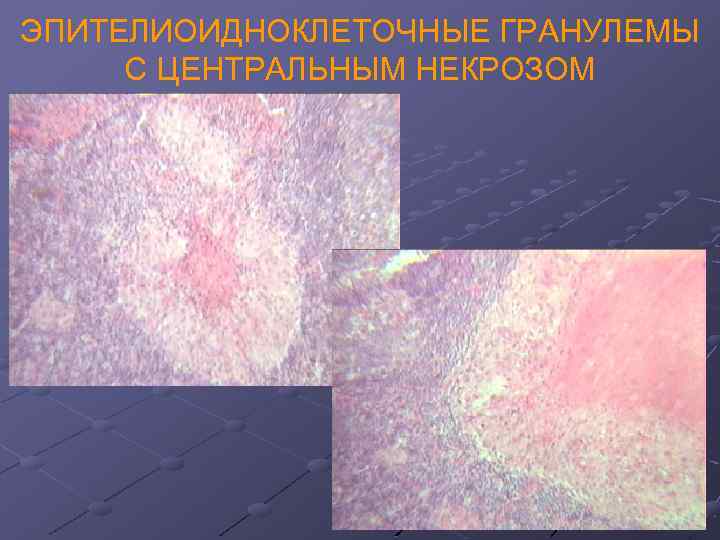 ЭПИТЕЛИОИДНОКЛЕТОЧНЫЕ ГРАНУЛЕМЫ С ЦЕНТРАЛЬНЫМ НЕКРОЗОМ 
