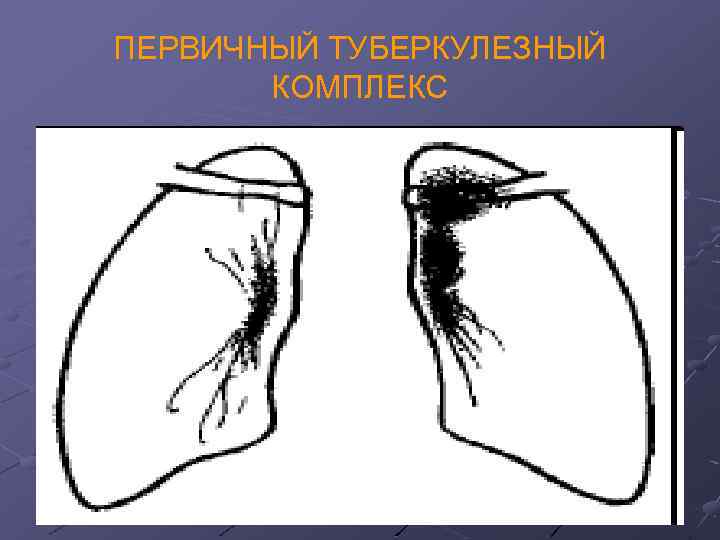 ПЕРВИЧНЫЙ ТУБЕРКУЛЕЗНЫЙ КОМПЛЕКС 