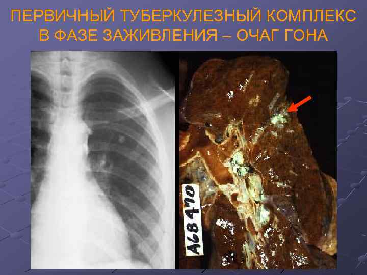ПЕРВИЧНЫЙ ТУБЕРКУЛЕЗНЫЙ КОМПЛЕКС В ФАЗЕ ЗАЖИВЛЕНИЯ – ОЧАГ ГОНА 