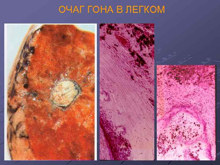 ОЧАГ ГОНА В ЛЕГКОМ 