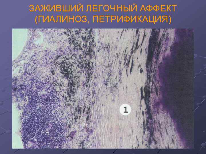 ЗАЖИВШИЙ ЛЕГОЧНЫЙ АФФЕКТ (ГИАЛИНОЗ, ПЕТРИФИКАЦИЯ) 