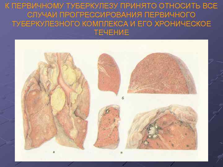 Первичный туберкулез. Первичный туберкулезный комплекс патанатомия. Первичный туберкулез патанатомия. Первичный туберкулез патологическая анатомия. Патологическая анатомия туберкулеза.