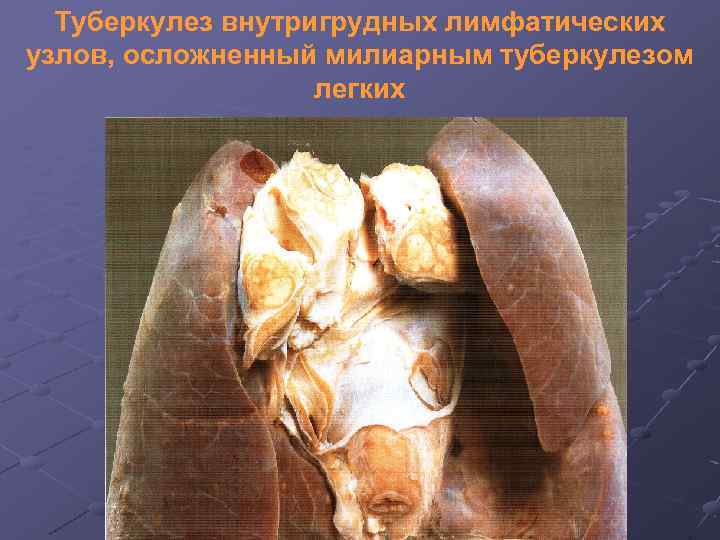 Туберкулез внутригрудных лимфатических узлов, осложненный милиарным туберкулезом легких 