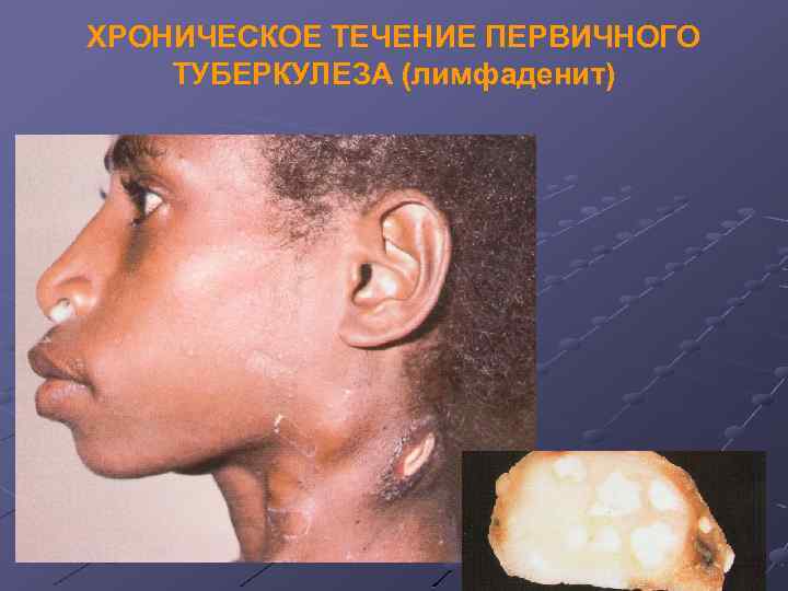 ХРОНИЧЕСКОЕ ТЕЧЕНИЕ ПЕРВИЧНОГО ТУБЕРКУЛЕЗА (лимфаденит) 