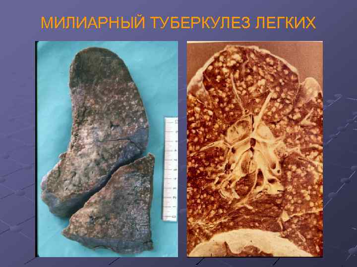 МИЛИАРНЫЙ ТУБЕРКУЛЕЗ ЛЕГКИХ 