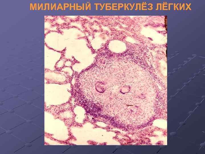 МИЛИАРНЫЙ ТУБЕРКУЛЁЗ ЛЁГКИХ 