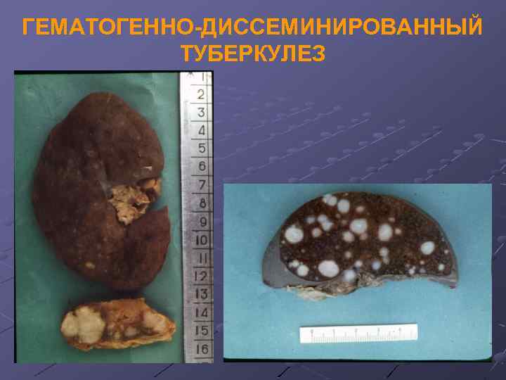ГЕМАТОГЕННО-ДИССЕМИНИРОВАННЫЙ ТУБЕРКУЛЕЗ 