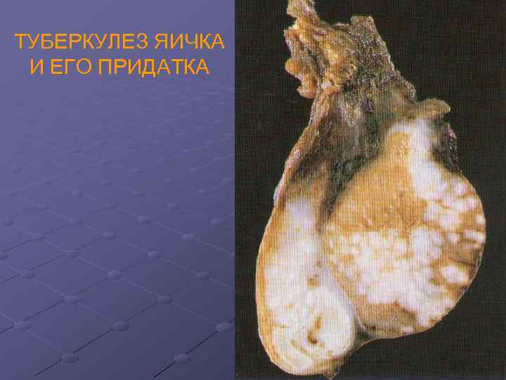 ТУБЕРКУЛЕЗ ЯИЧКА И ЕГО ПРИДАТКА 