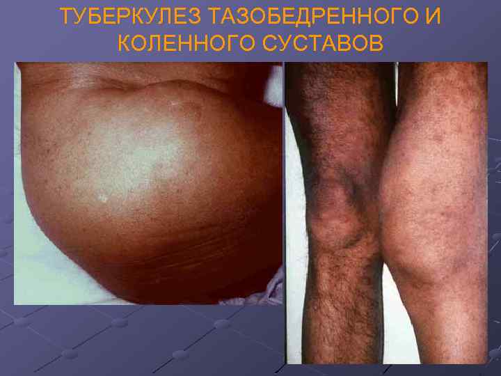 ТУБЕРКУЛЕЗ ТАЗОБЕДРЕННОГО И КОЛЕННОГО СУСТАВОВ 