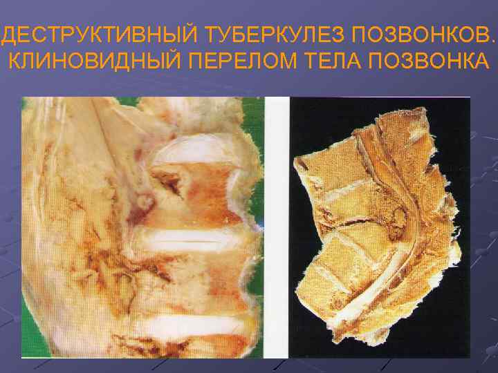 ДЕСТРУКТИВНЫЙ ТУБЕРКУЛЕЗ ПОЗВОНКОВ. КЛИНОВИДНЫЙ ПЕРЕЛОМ ТЕЛА ПОЗВОНКА 