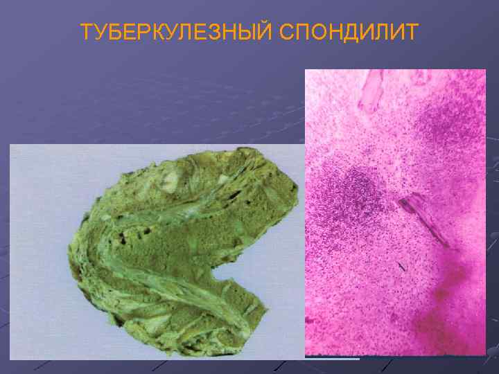 ТУБЕРКУЛЕЗНЫЙ СПОНДИЛИТ 