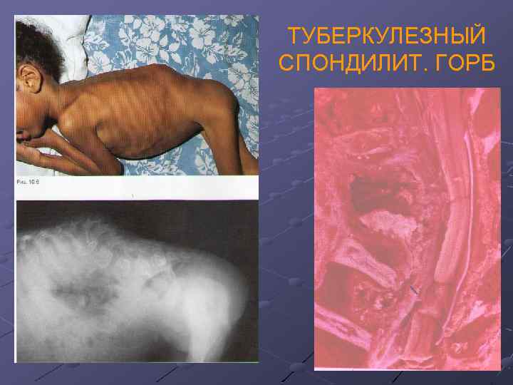 ТУБЕРКУЛЕЗНЫЙ СПОНДИЛИТ. ГОРБ 