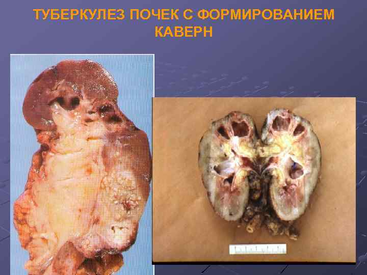 ТУБЕРКУЛЕЗ ПОЧЕК С ФОРМИРОВАНИЕМ КАВЕРН 