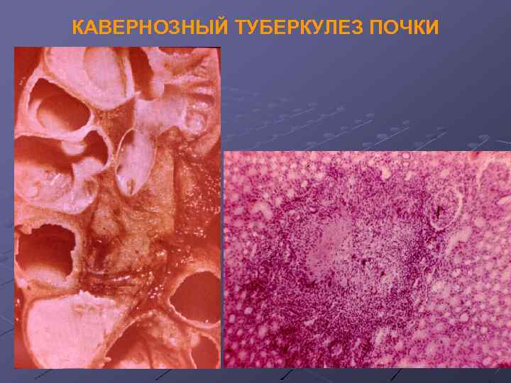 КАВЕРНОЗНЫЙ ТУБЕРКУЛЕЗ ПОЧКИ 