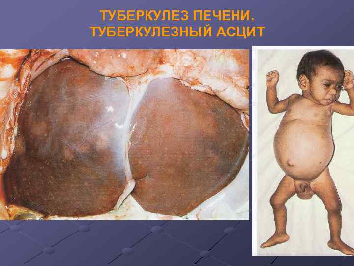 ТУБЕРКУЛЕЗ ПЕЧЕНИ. ТУБЕРКУЛЕЗНЫЙ АСЦИТ 