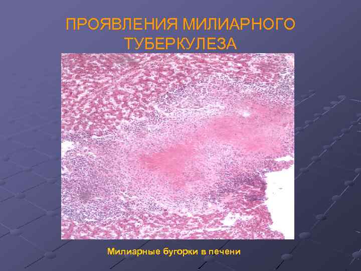 ПРОЯВЛЕНИЯ МИЛИАРНОГО ТУБЕРКУЛЕЗА Милиарные бугорки в печени 