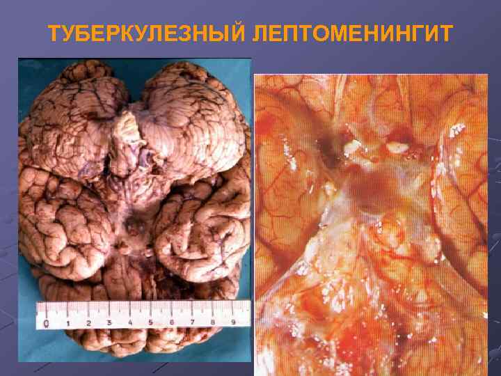 ТУБЕРКУЛЕЗНЫЙ ЛЕПТОМЕНИНГИТ 